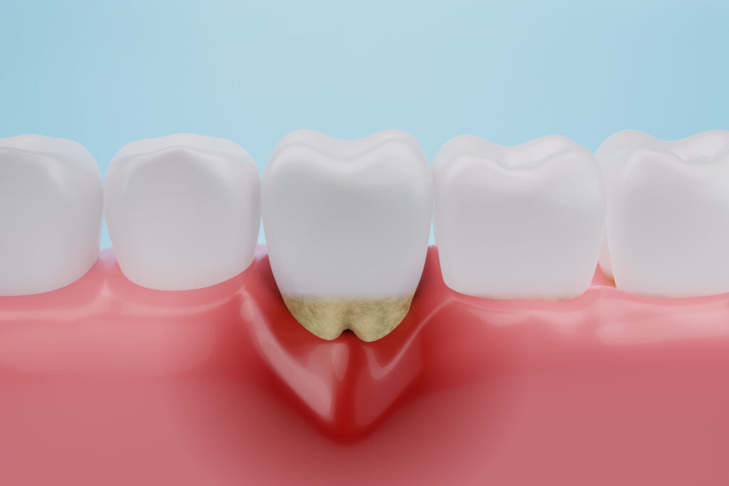 歯槽膿漏のイメージ